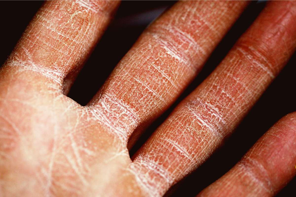 Close-up of hand showing dry, cracked skin texture, highlighting visible lines and patterns. Detailed focus on skin's surface, providing an examination of its condition. Dark background for contrast.