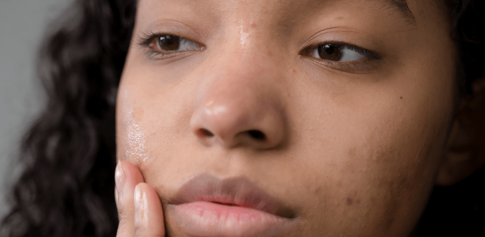 Moisturizing for Acneic Skin - Dubois Beauty & Wellness