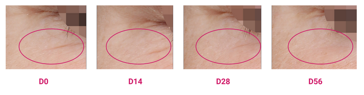 photo of the change of skin over time with treatment